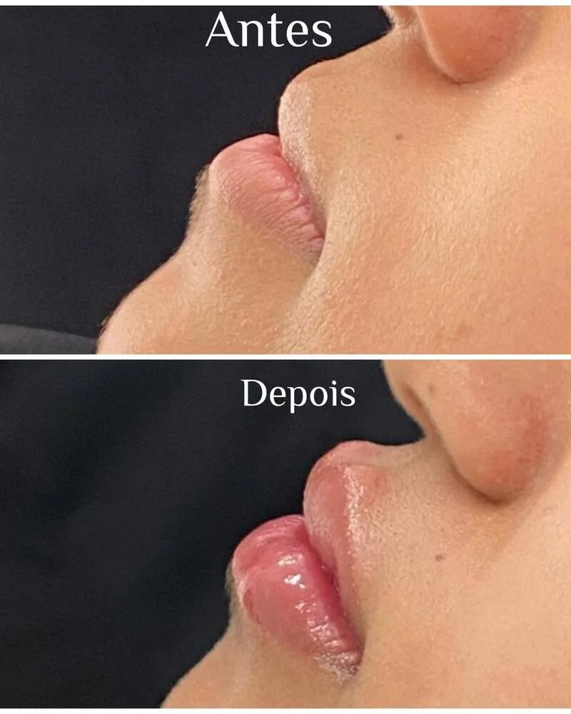 Lábios de perfil antes e depois do preenchimento, com mais projeção na foto de baixo