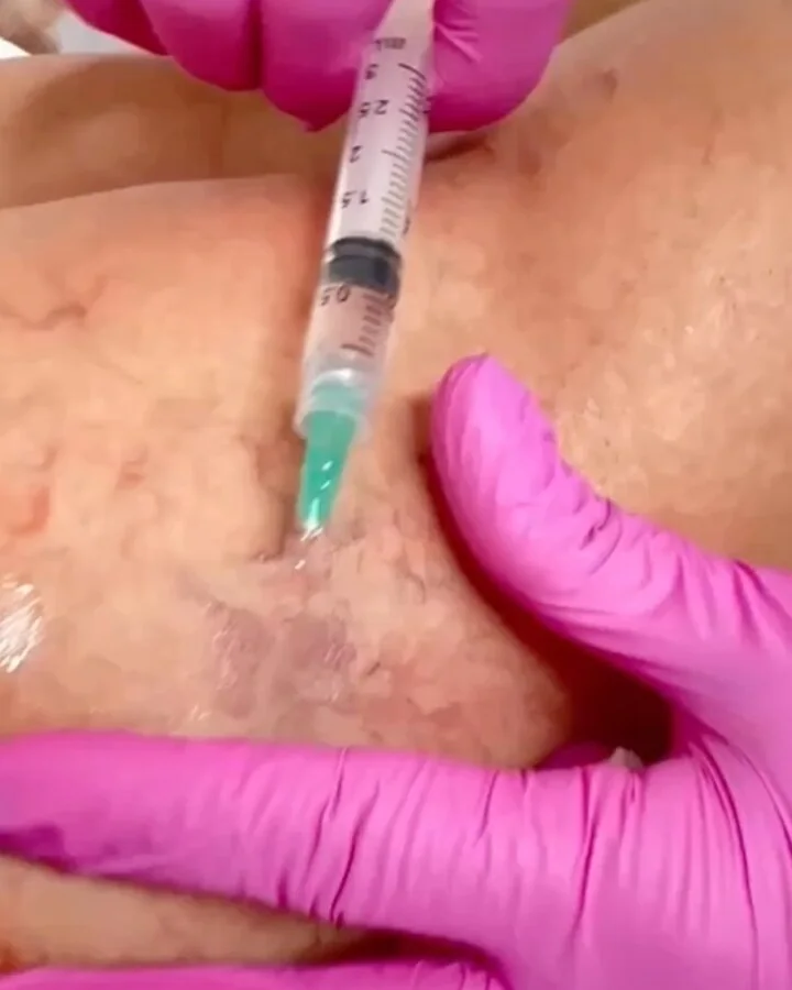 Aplicação do PEIM para secar os vasinhos da perna