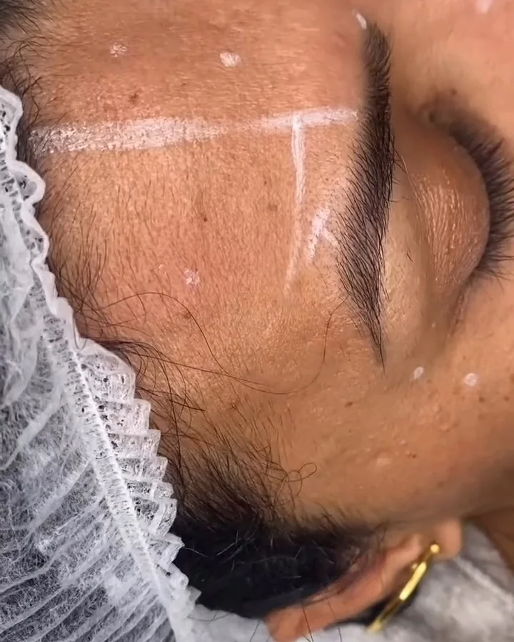 Aplicação de toxina botulínica na testa, com os pontos marcados