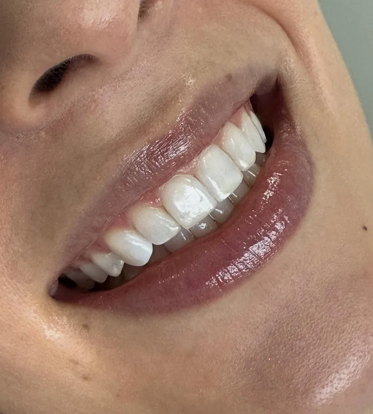 Sorriso de uma paciente depois de facetas em resina, com dentes claros e naturais